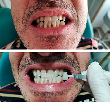 antesdespuesesteticadental